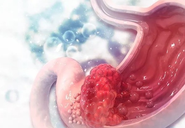 筛查|上海人警惕胃癌元凶!这些情况需要做胃镜