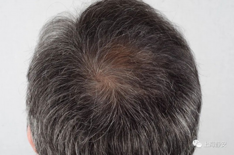 坏习惯|年纪轻轻就白发?注意!这些坏习惯正在加速白发的生成……