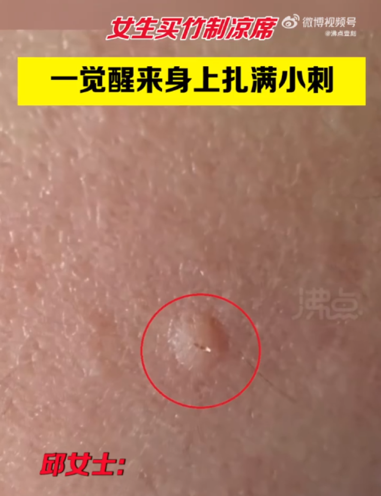 刺猬|真·凉席刺客?女子睡了新买的凉席,一觉醒来身上扎满刺!夏季凉席应该怎么选?